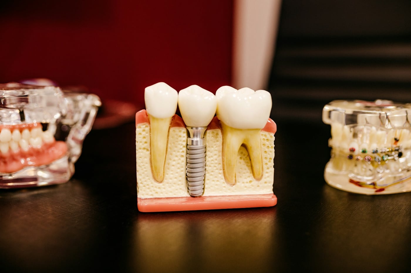 Modelo odontológico mostrando um implante entre dois dentes naturais